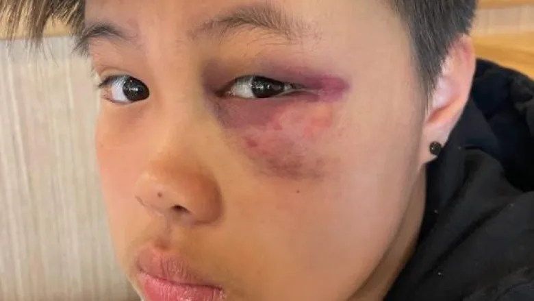 B.C. teen beaten unconscious feared return to school but says friends and counsellors helped